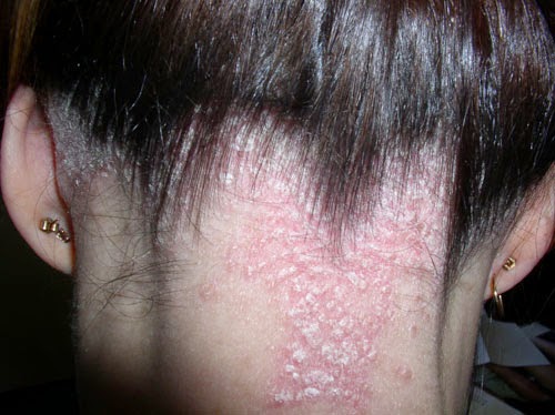 Bệnh nấm da đầu ở phụ nữ.