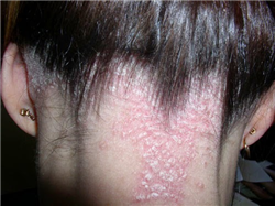 Nguyên nhân và cách phòng tránh bệnh nấm da đầu.