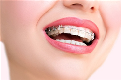 Tất tần tật các bước của quy trình niềng răng.