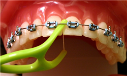 Vệ sinh răng miệng như thế nào sau khi gắn mắc cài niềng răng?